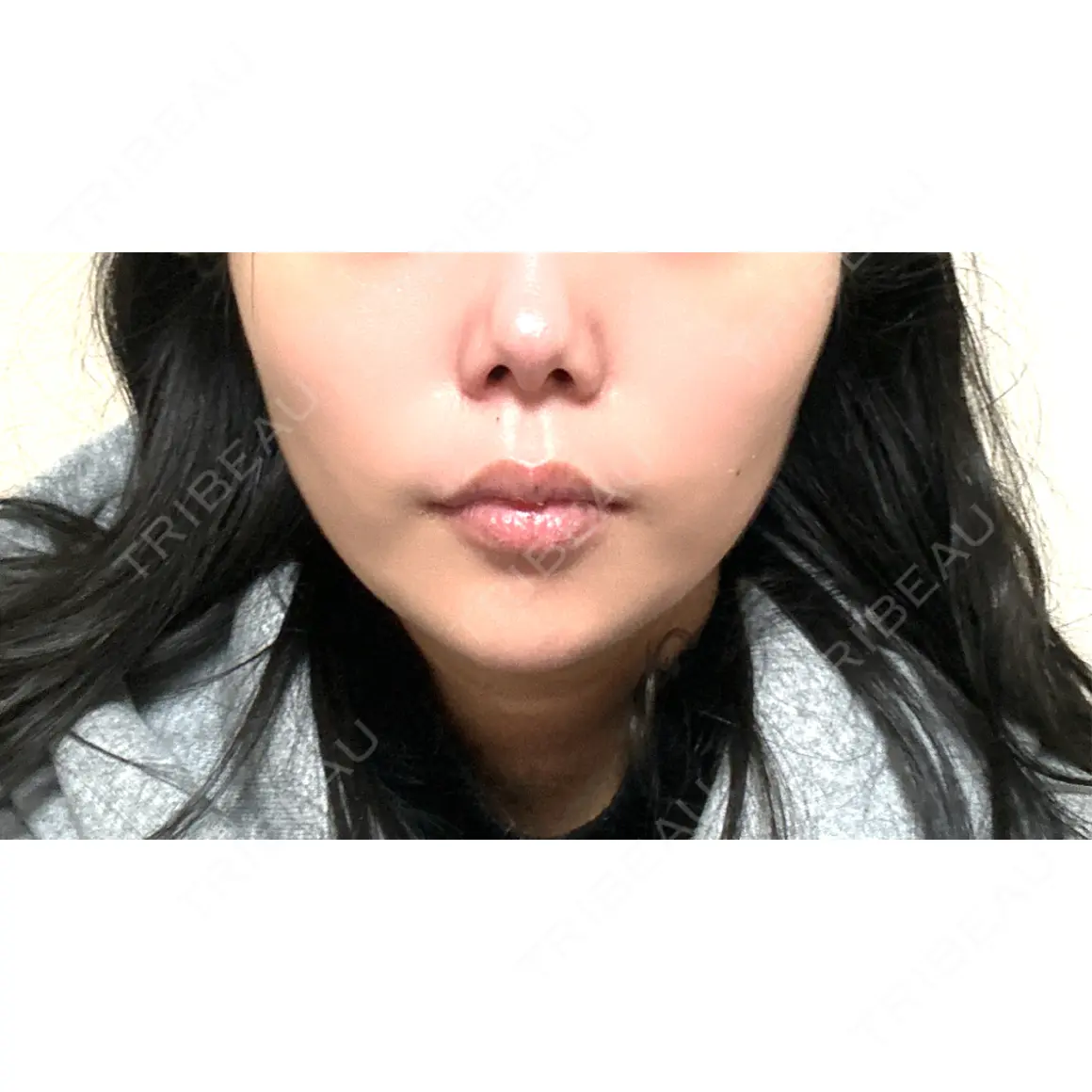 ボトックス（あご） ルラ美容クリニック 町田院 AFTER