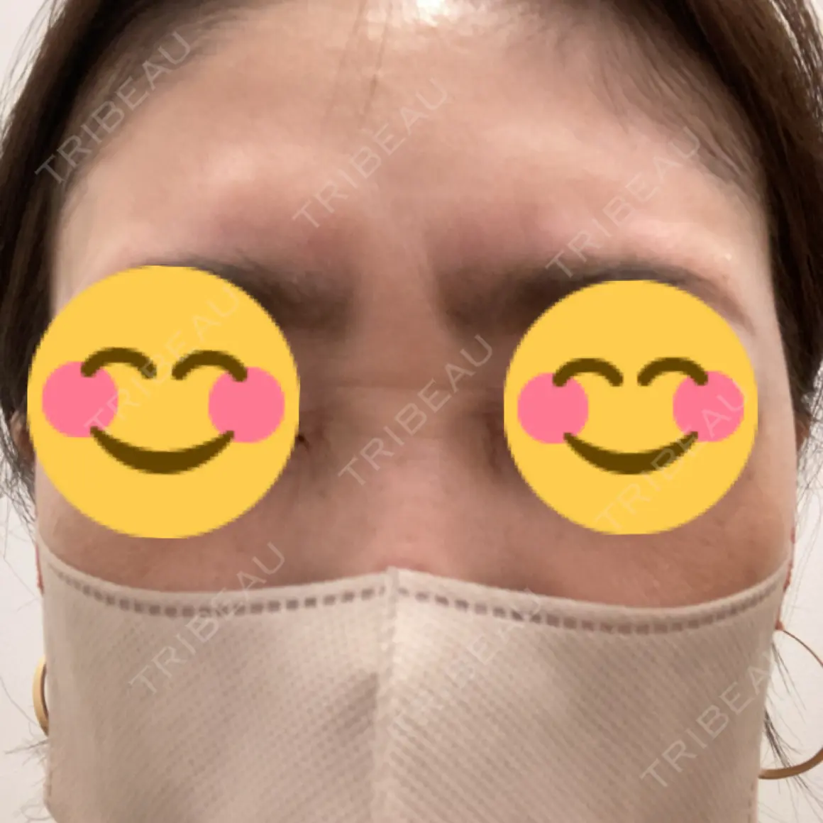 ボトックス（眉間） PRO CLINIC プロクリニック 銀座院 DAY 0