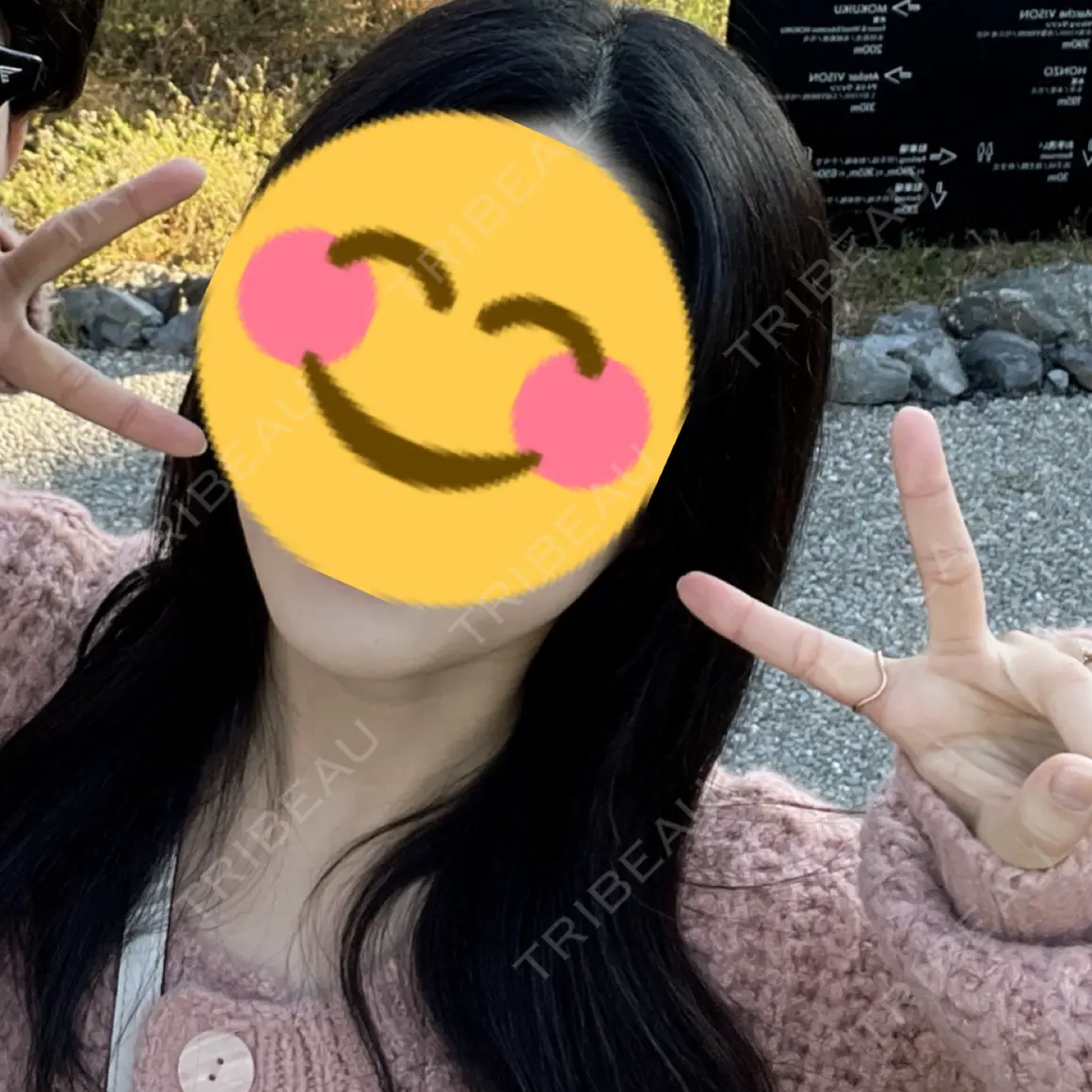 ボトックス（エラ・小顔） TCB東京中央美容外科 奈良院 DAY 1