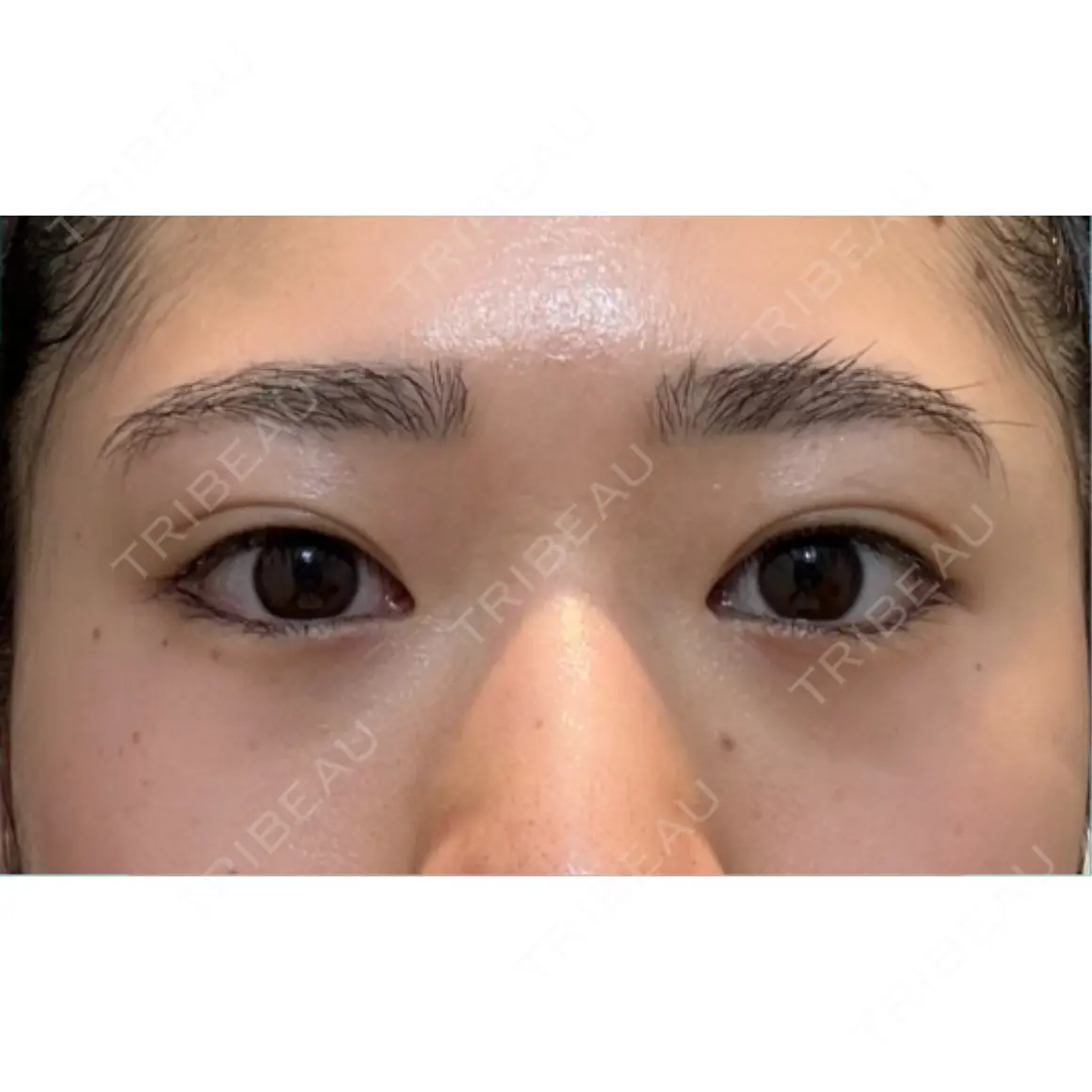 クマ治療 / 下まぶたの脂肪取り EMMO FACE CLINIC 東京三田院 AFTER