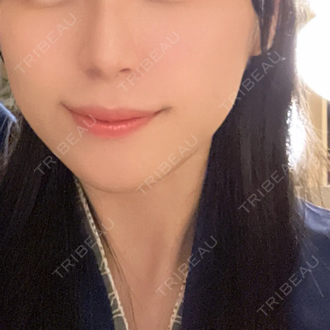 ボトックス（エラ・小顔） TCB東京中央美容外科 奈良院 AFTER