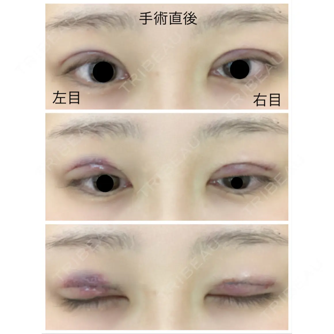 二重切開 オアシス美容外科 DAY 0