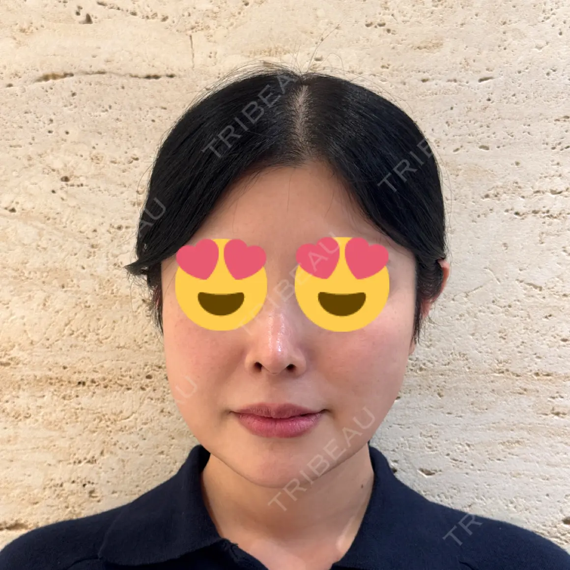 鼻尖形成（切開） / 脂肪吸引（顔） / 鼻孔縁下降 / あご下筋肉縛り / その他（鼻） LUHO（ルホ）美容外科 DAY 30
