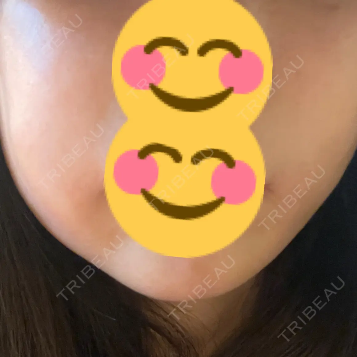 脂肪溶解注射（顔） AZ BEAUTY CLINIC DAY 0