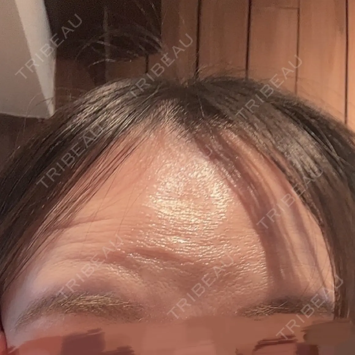 ボトックス（眉間） / ボトックス（額） PRO CLINIC プロクリニック 銀座院 AFTER