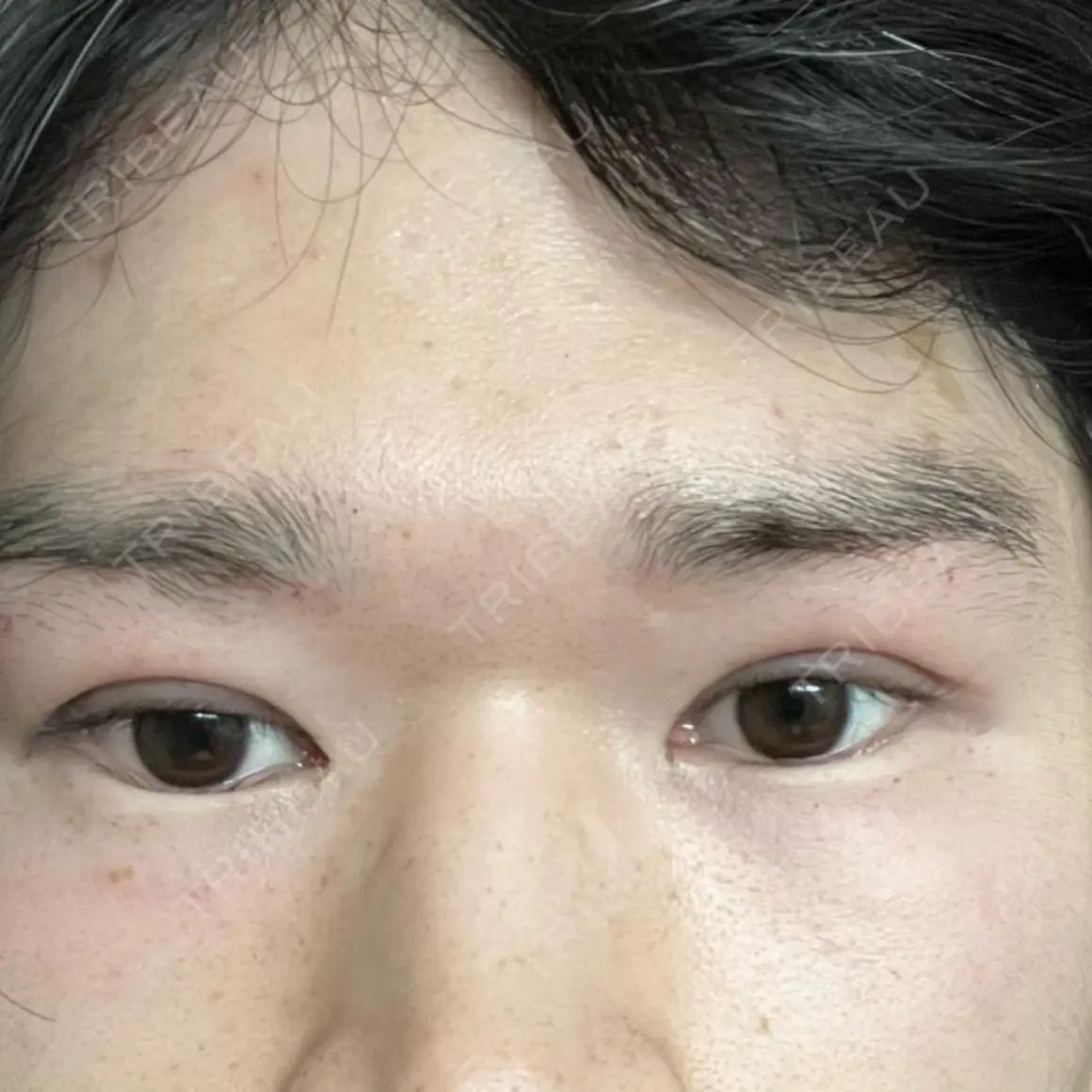 二重切開 / 眼瞼下垂（切開） / 下まぶたたるみ取り / 目元修正 WOM CLINIC GINZA （ワム クリニック ギンザ） DAY 0