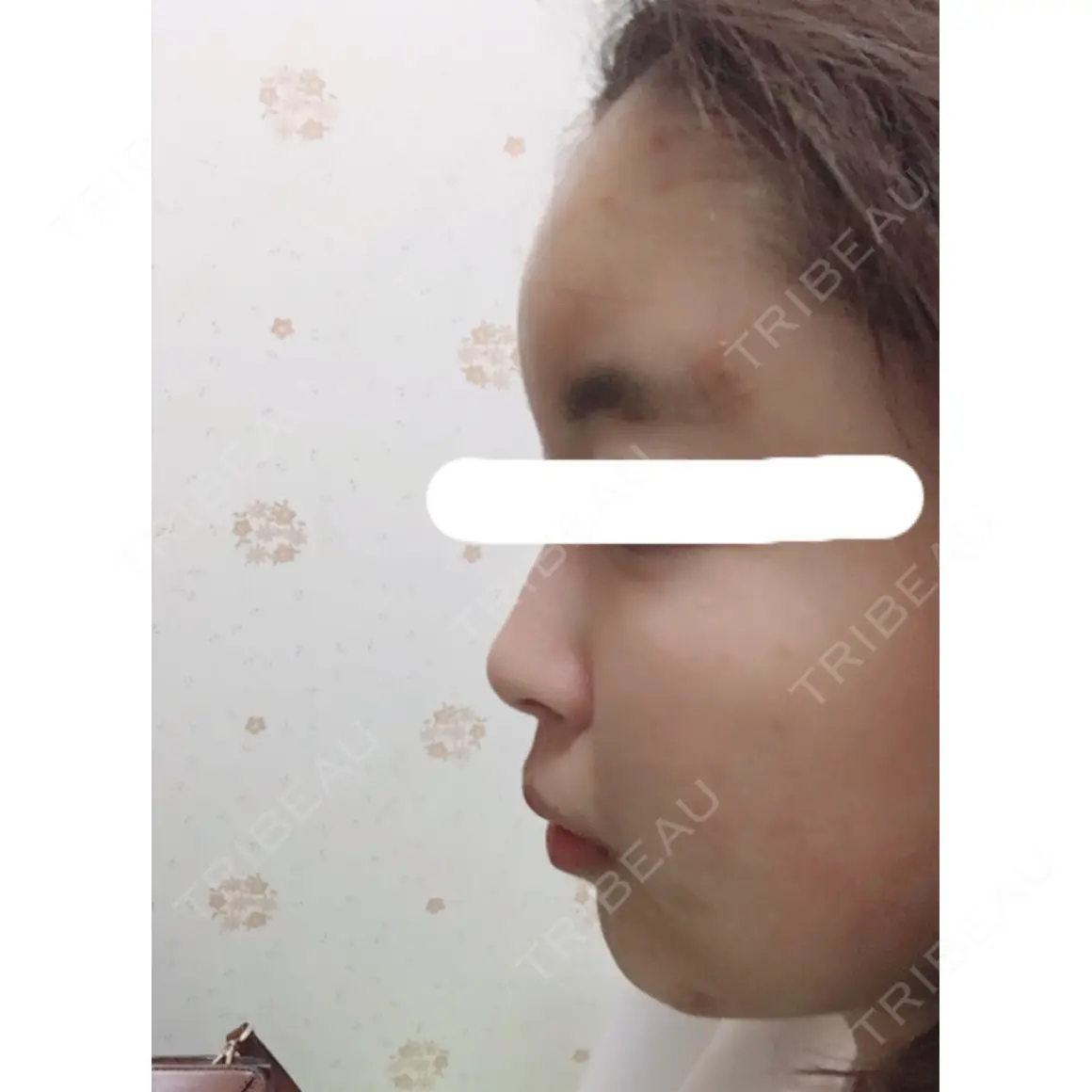 脂肪注入（輪郭） / 再生医療 / PRP皮膚再生療法 チョンダムオラクル皮膚科整形外科医院 DAY 0