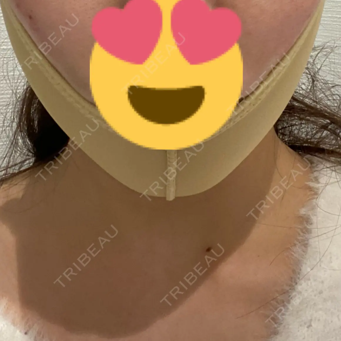 糸リフト / ジョールファット除去 R Beauty CLINIC 大阪院 DAY 0
