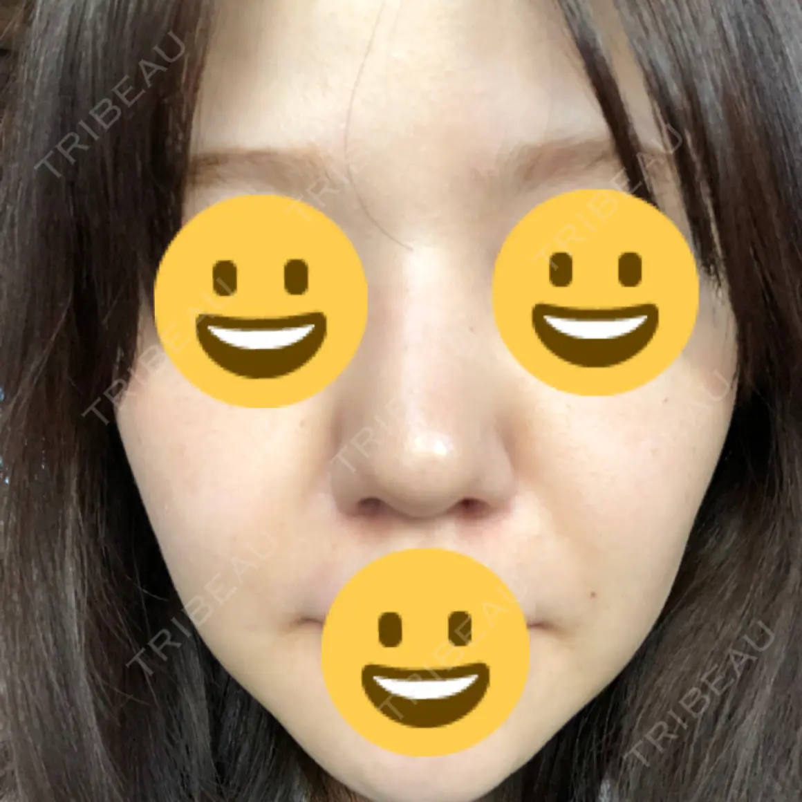 鼻尖形成（切開） / 鼻中隔延長（切開） / 小鼻縮小（切開） / 骨切幅寄せ / ボトックス（エラ・小顔） / 毛穴洗浄（ハイドラフェイシャルなど） BIANCA銀座 DAY 21
