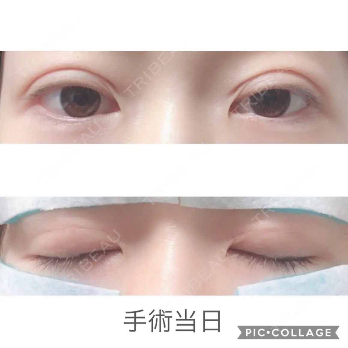 二重埋没 湘南美容クリニック 新宿本院 DAY 0