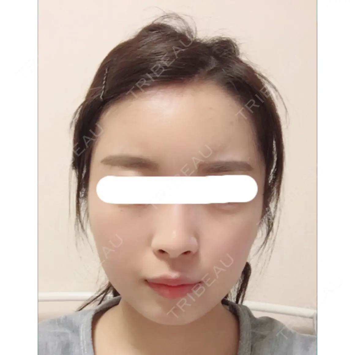 脂肪注入（輪郭） / 再生医療 / PRP皮膚再生療法 チョンダムオラクル皮膚科整形外科医院 AFTER