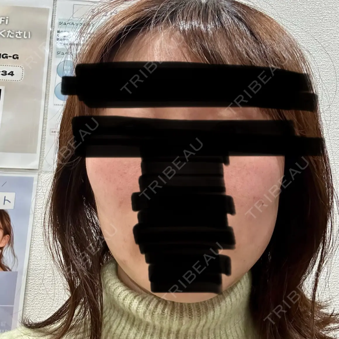 美肌レーザー / 医療脱毛（顔） / その他（輪郭） ビューティー和心クリニック 浅草院 AFTER