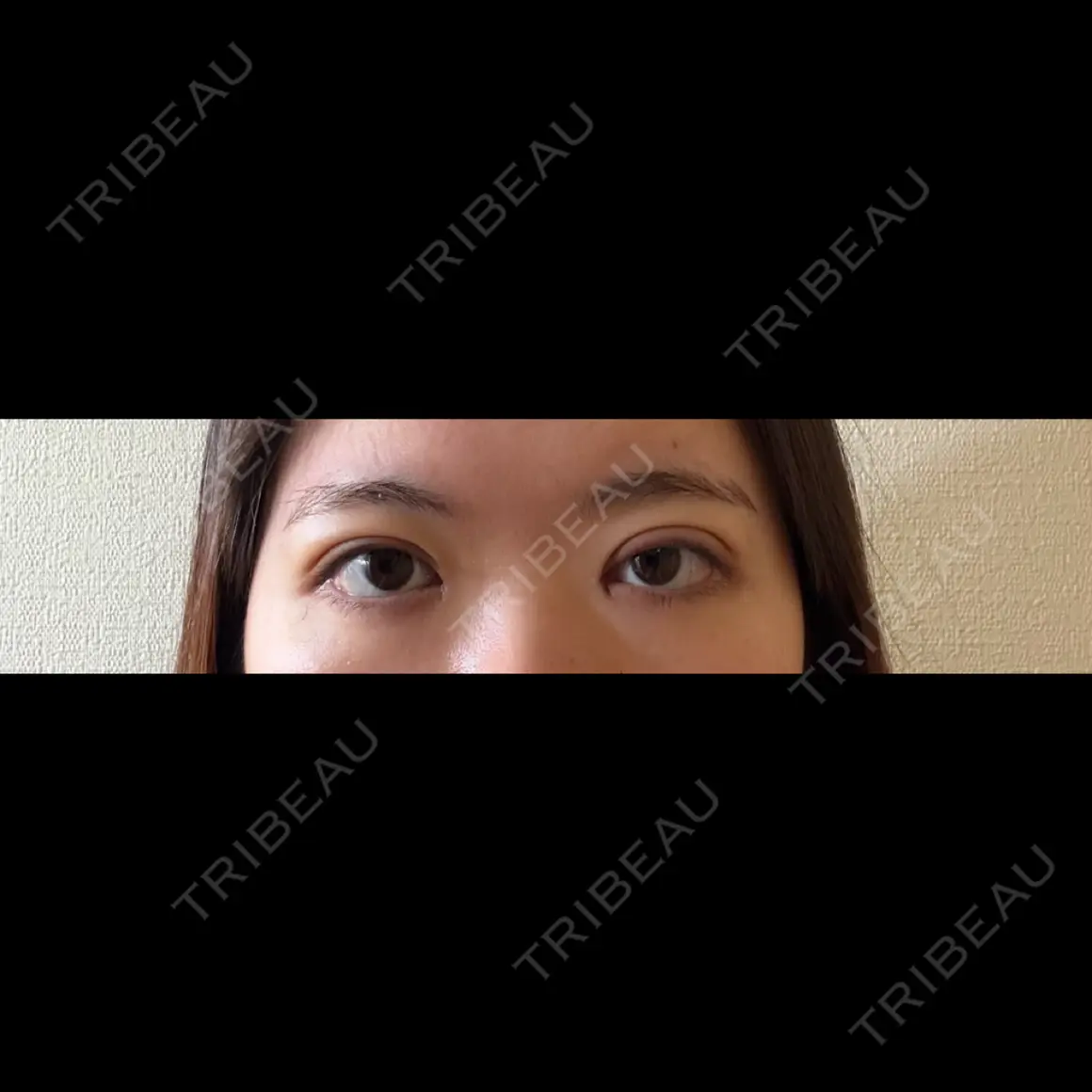 二重埋没 / 目頭切開 / 糸リフト / 脂肪吸引（顔） HAAB×DREAM BEAUTY CLINIC 東京本院 DAY 8