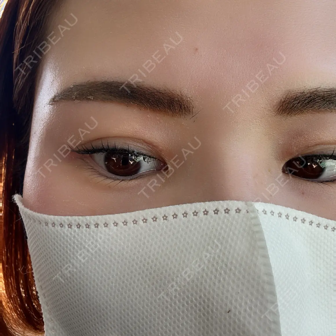 目頭切開 / その他（目元） Leap beauty clinic AFTER