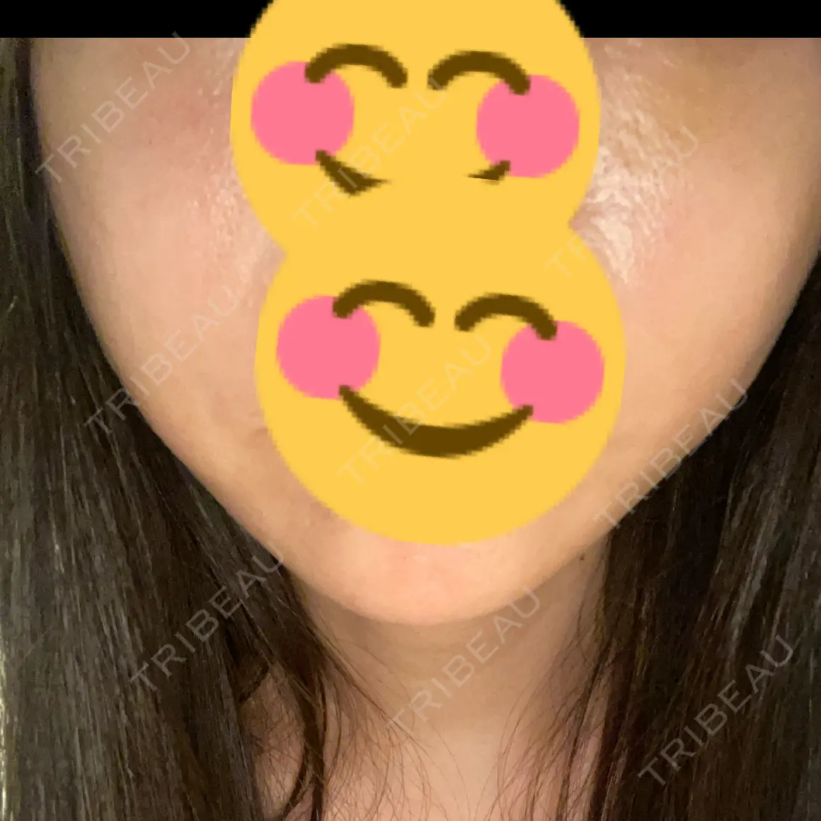 脂肪溶解注射（顔） AZ BEAUTY CLINIC AFTER