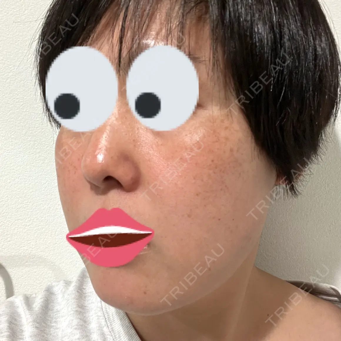イオン導入 / ピコレーザートーニング（美白・肝斑） アスク美容クリニック銀座 AFTER