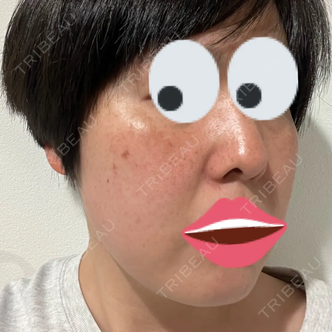 イオン導入 / ピコレーザートーニング（美白・肝斑） アスク美容クリニック銀座 AFTER
