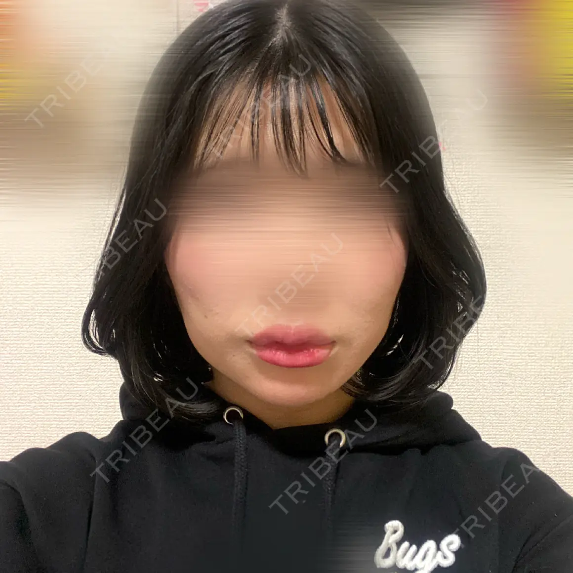 ヒアルロン酸注入（あご） フィラークリニック 新宿院 AFTER