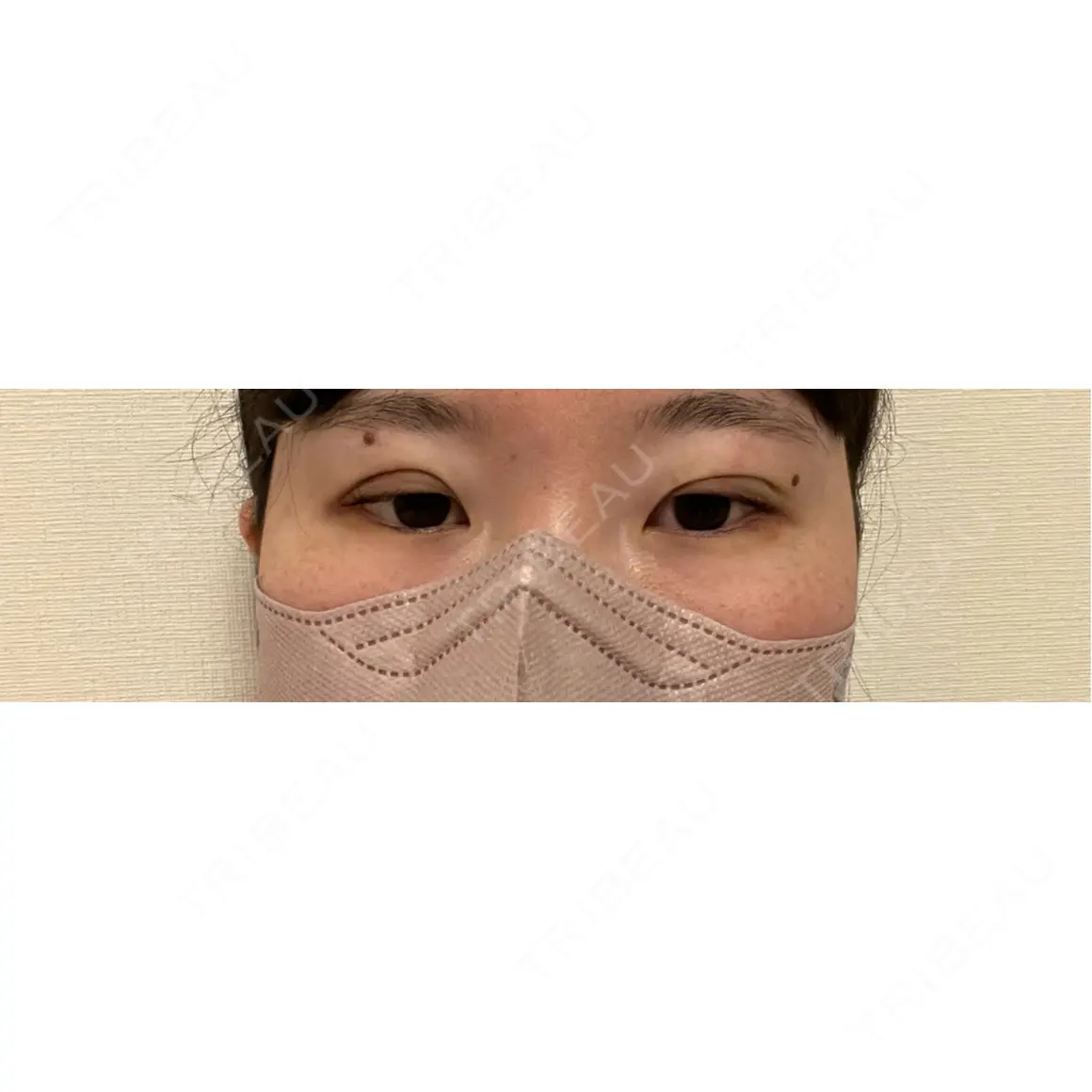 二重埋没 / 上まぶたの脂肪取り 湘南美容クリニック 西葛西院 DAY 0