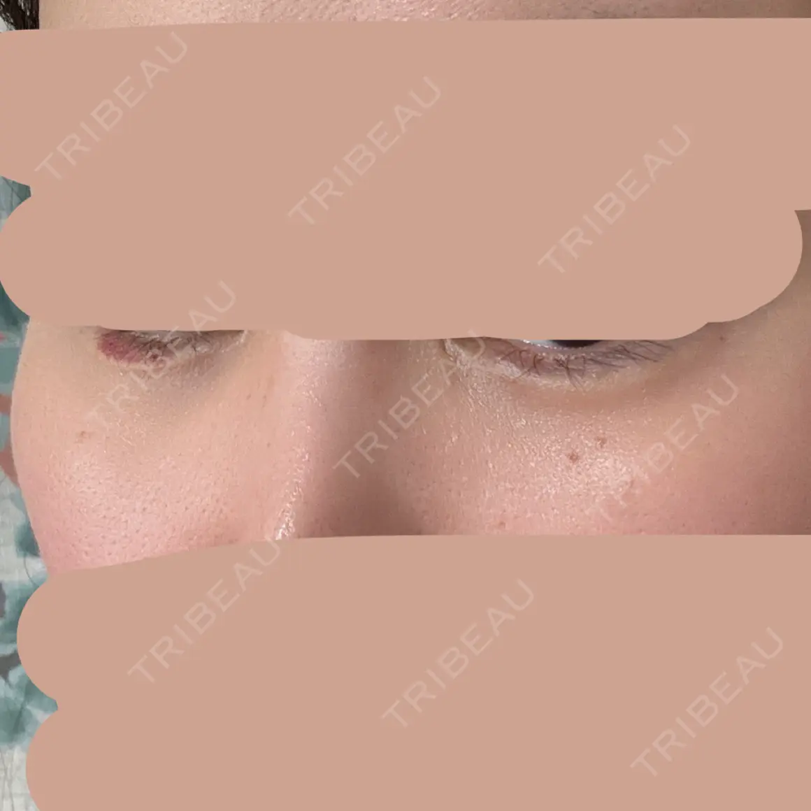ヒアルロン酸注入（涙袋） / ヒアルロン酸注入（唇） PRO CLINIC プロクリニック 銀座院 AFTER