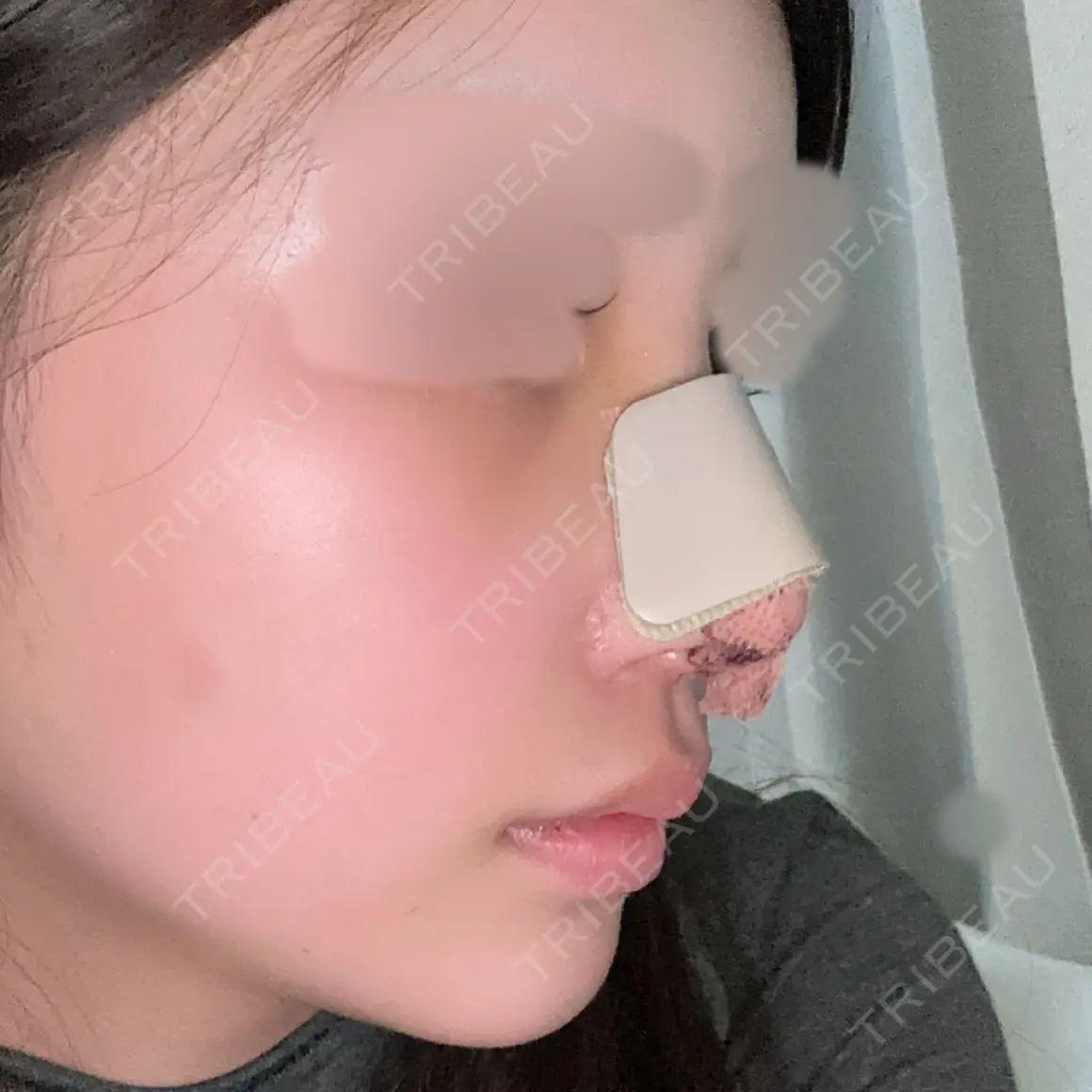 鼻尖形成（切開） / 軟骨移植 / 骨切幅寄せ / ワシ鼻修正・ハンプ切除 WOM CLINIC GINZA （ワム クリニック ギンザ） DAY 3