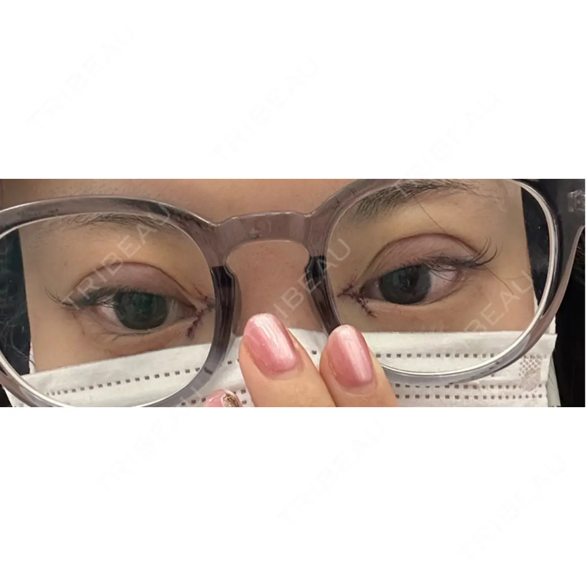二重埋没 / 目頭切開 MIL CLINIC OSAKA DAY 0