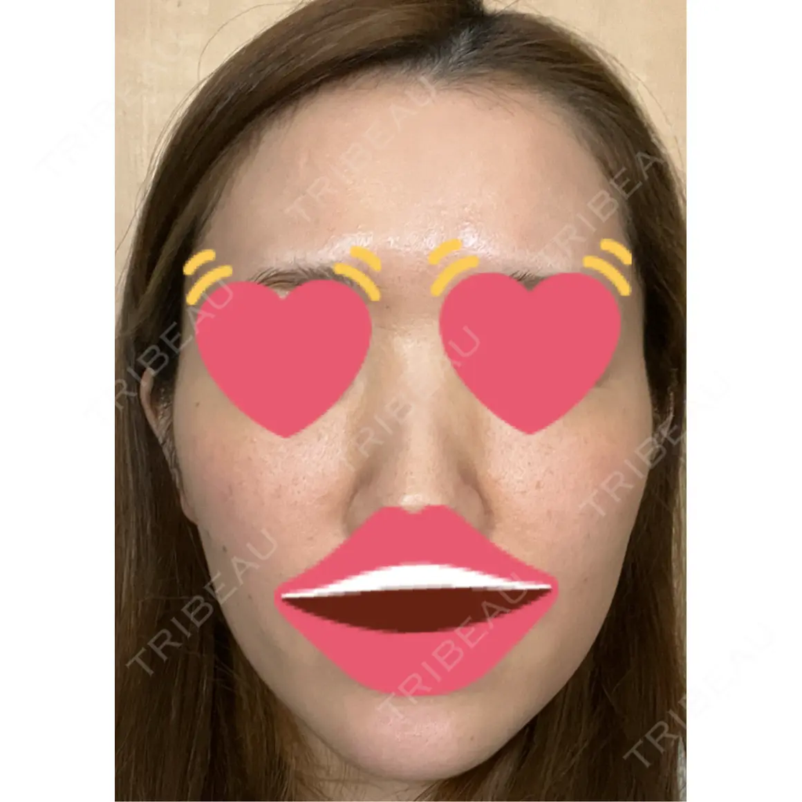 美肌レーザー / 美白レーザー / ピコレーザートーニング（美白・肝斑） 銀座みゆき通り美容外科 大阪梅田院 DAY 0