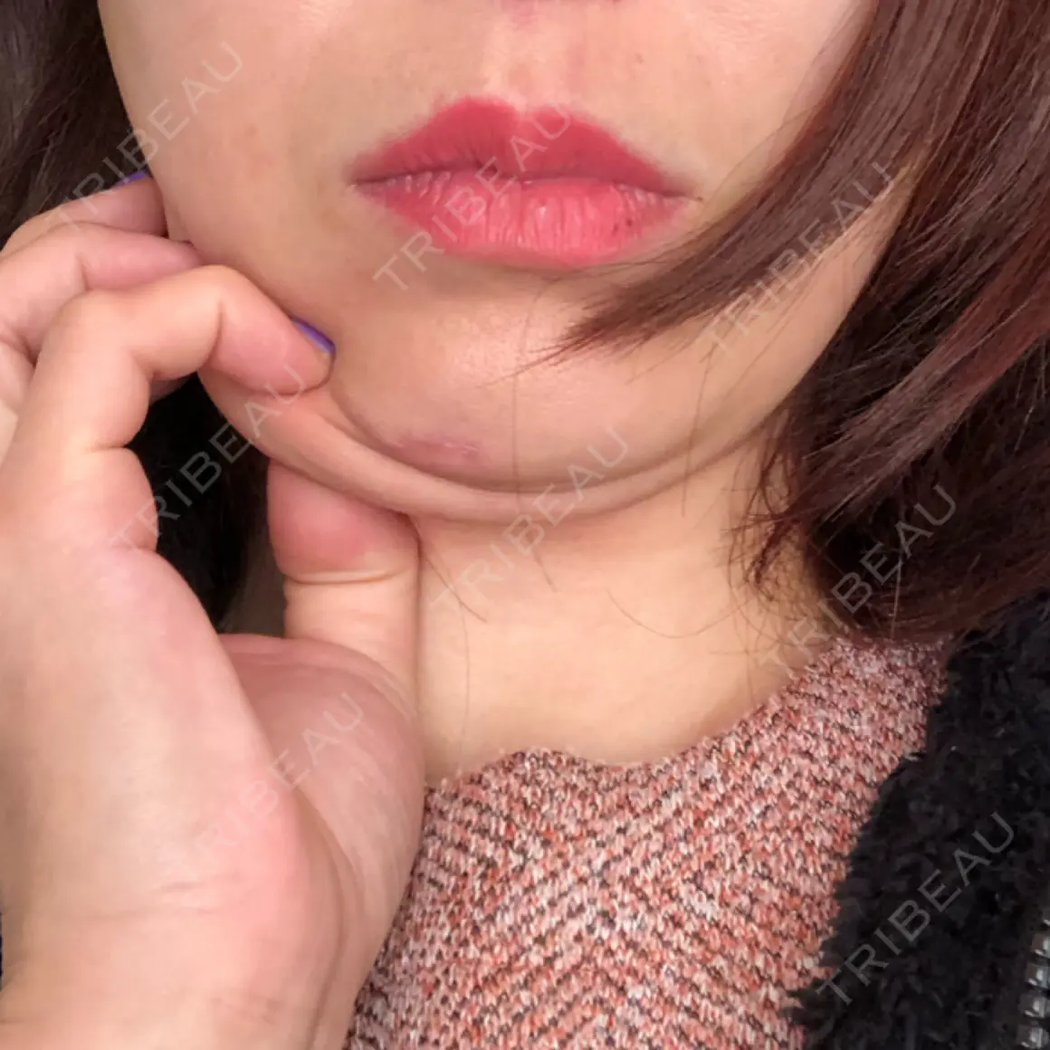 脂肪吸引注射（顔） 湘南美容クリニック 甲府院 AFTER