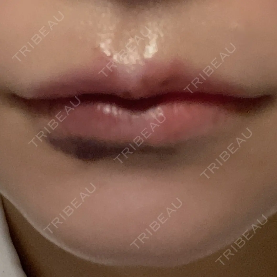 ボトックス（口角） ブルームクリニック（BLOOM CLINIC） AFTER