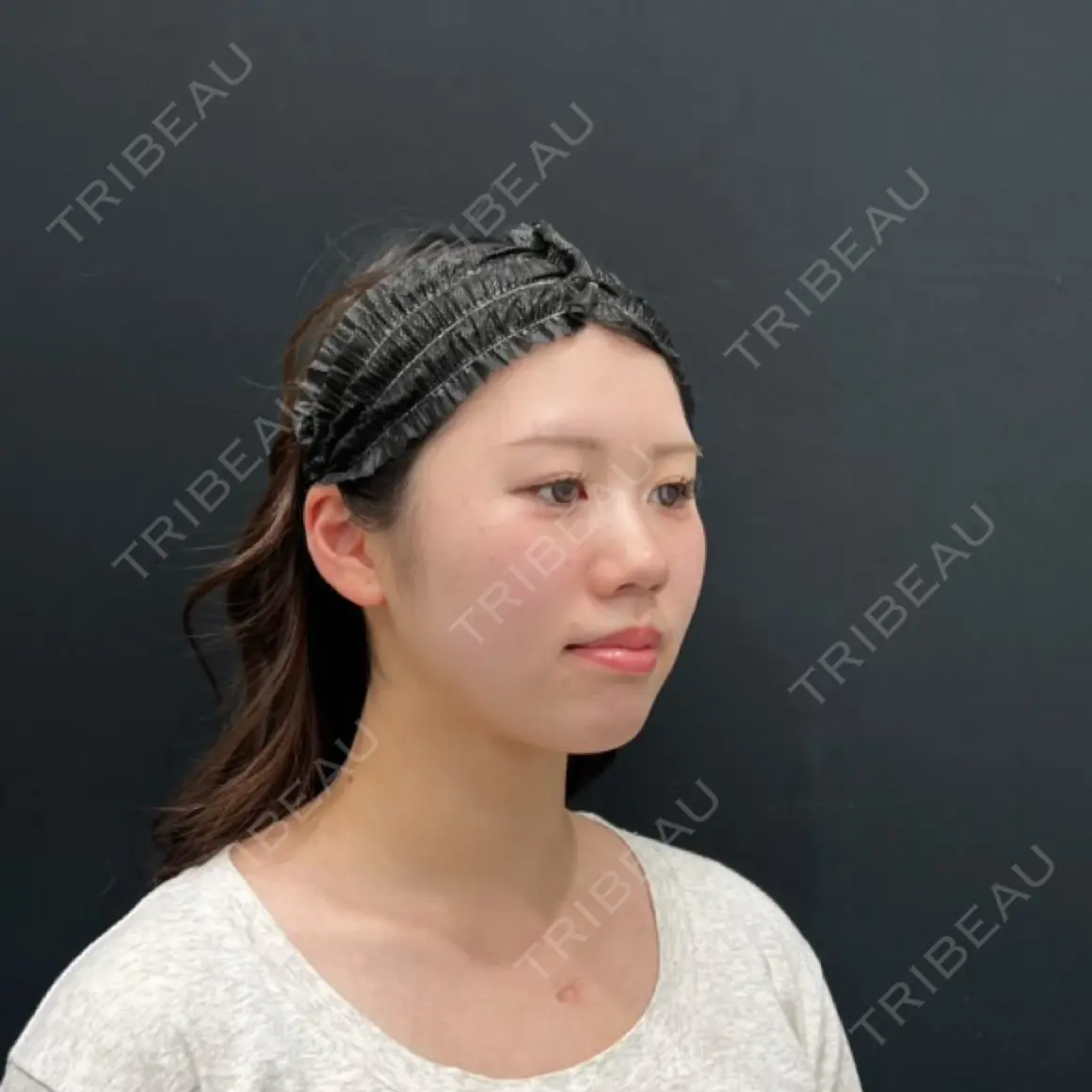脂肪吸引（顔） / 脂肪注入（輪郭） 湘南美容クリニック 吉祥寺院 AFTER