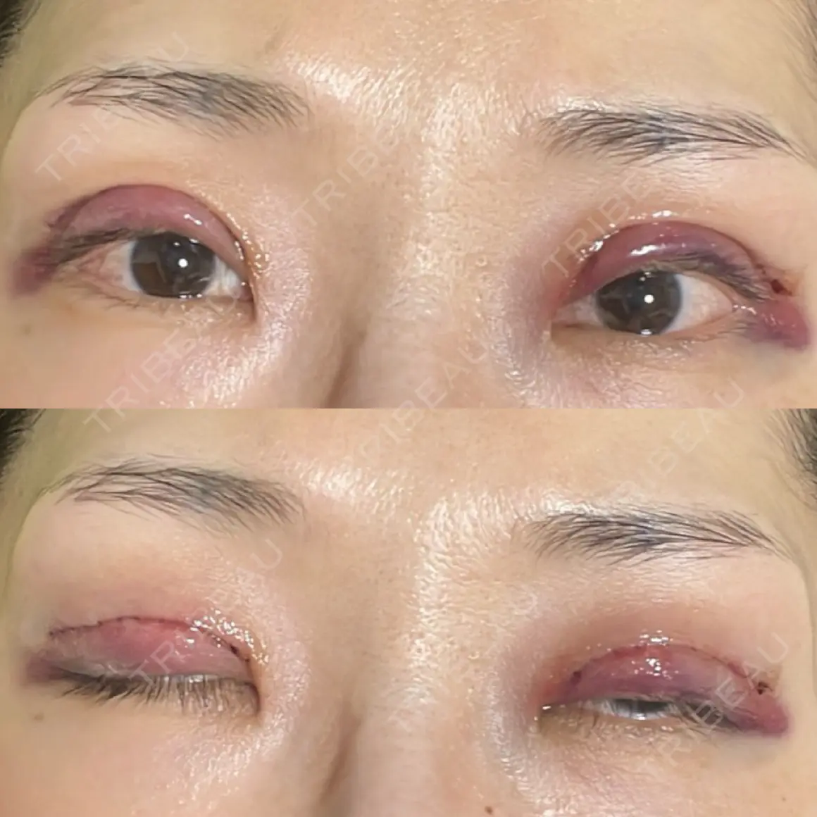 二重切開 / 眼瞼下垂（切開） / 上まぶたの脂肪取り オーキッド美容クリニック東京御徒町 DAY 0