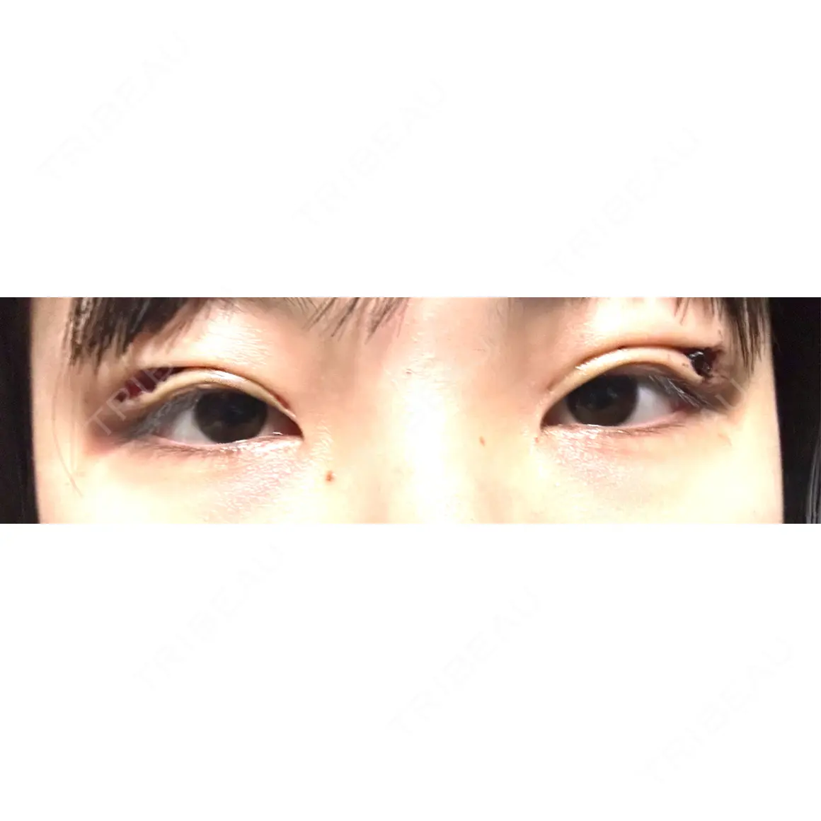二重埋没 / 上まぶたの脂肪取り THE FIRST CLINIC 多摩センター院 DAY 0