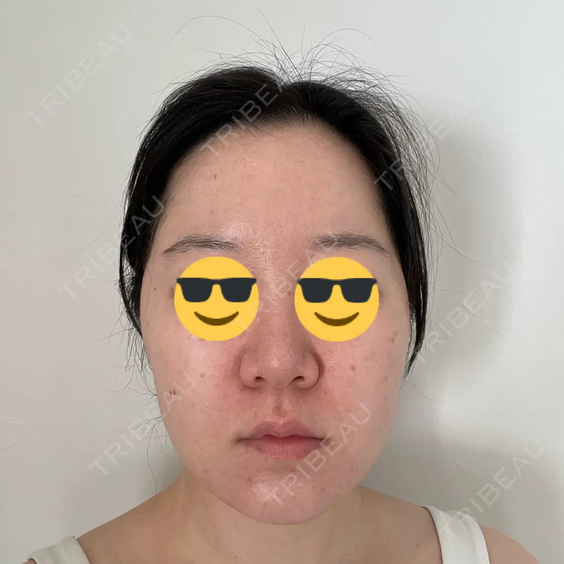 脂肪吸引（顔） Mods Clinic（モッズクリニック） 大阪院 DAY 35