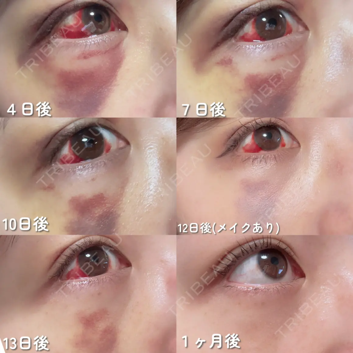 クマ治療 PRISM Beauty Clinic AFTER
