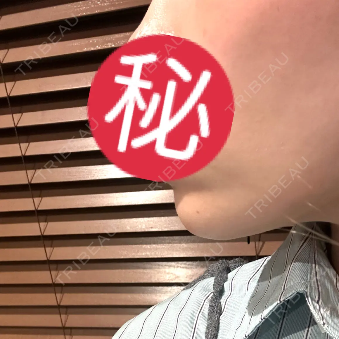 ヒアルロン酸注入（あご） ブルームクリニック（BLOOM CLINIC） AFTER