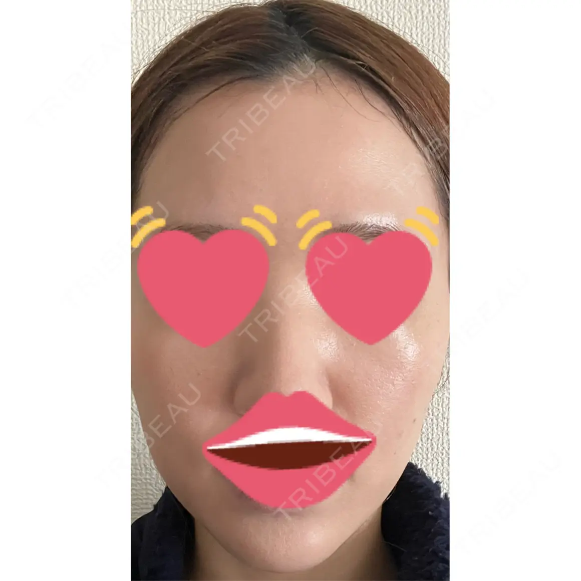 美肌レーザー / 美白レーザー / ピコレーザートーニング（美白・肝斑） 銀座みゆき通り美容外科 大阪梅田院 AFTER