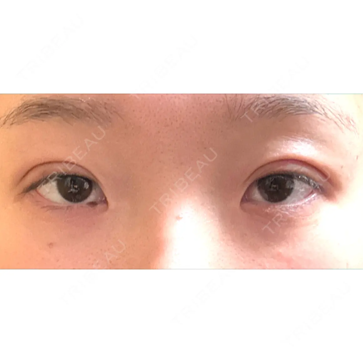 二重埋没 湘南美容クリニック 千葉センシティ院 DAY 0