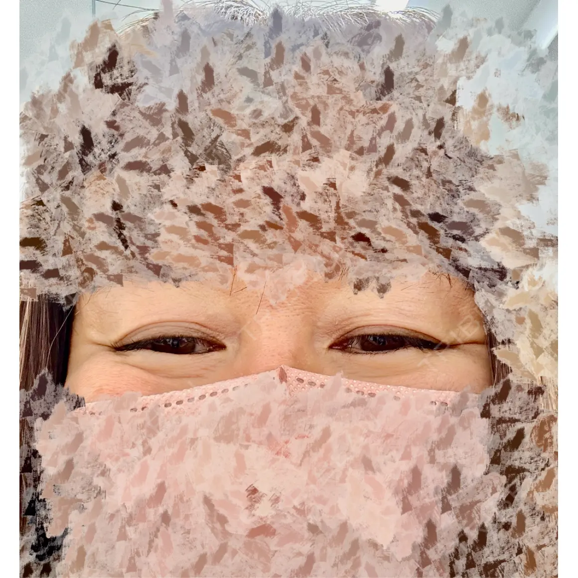 美容点滴・美容注射（疲労回復） / その他（目元） TCB東京中央美容外科 福岡天神院 AFTER