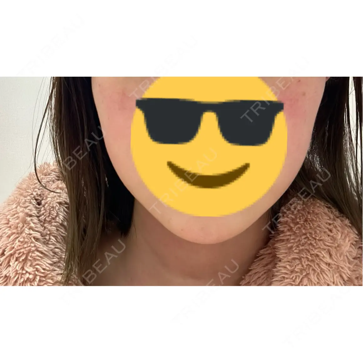 ボトックス（エラ・小顔） 共立美容外科 渋谷院 AFTER