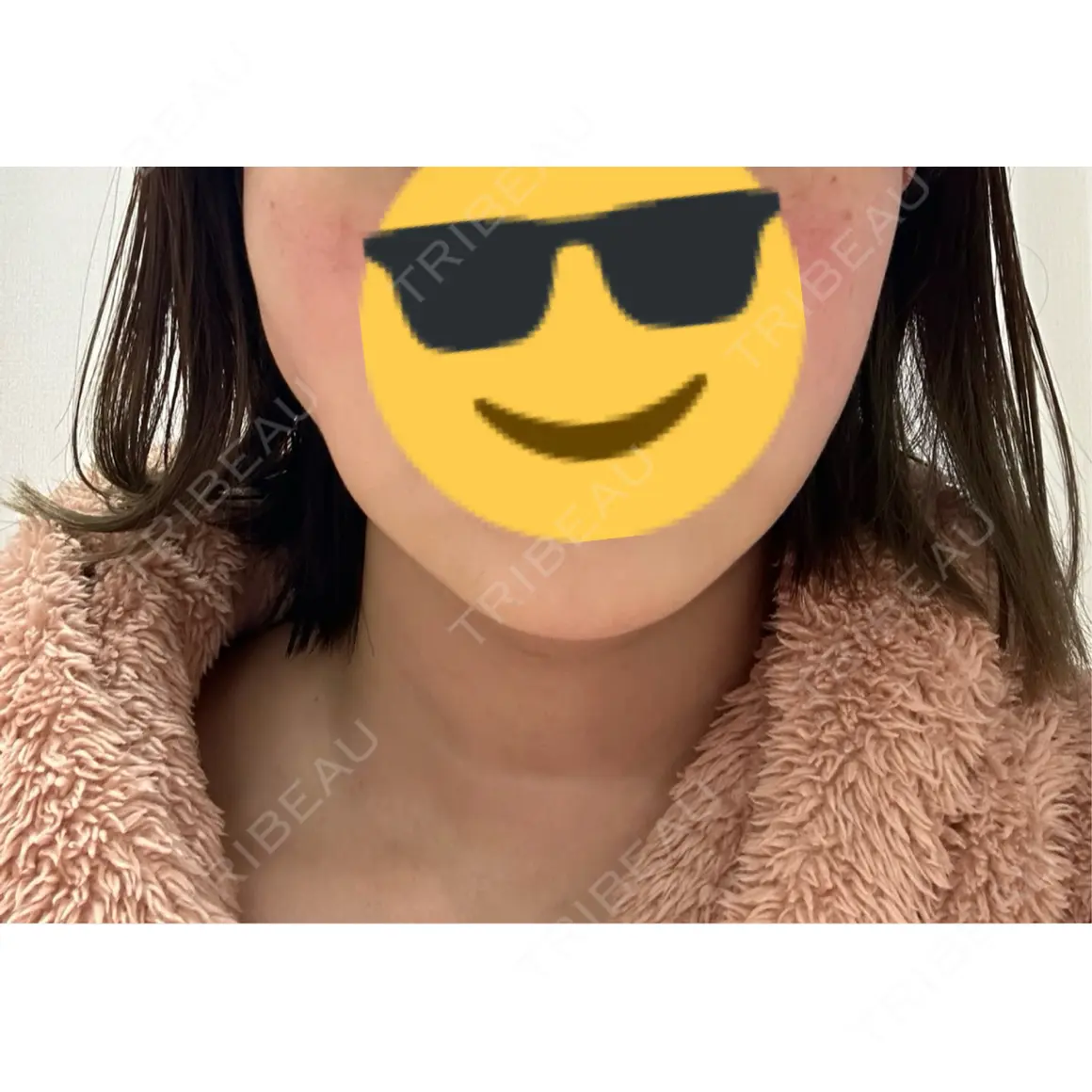 ボトックス（エラ・小顔） 共立美容外科 渋谷院 AFTER