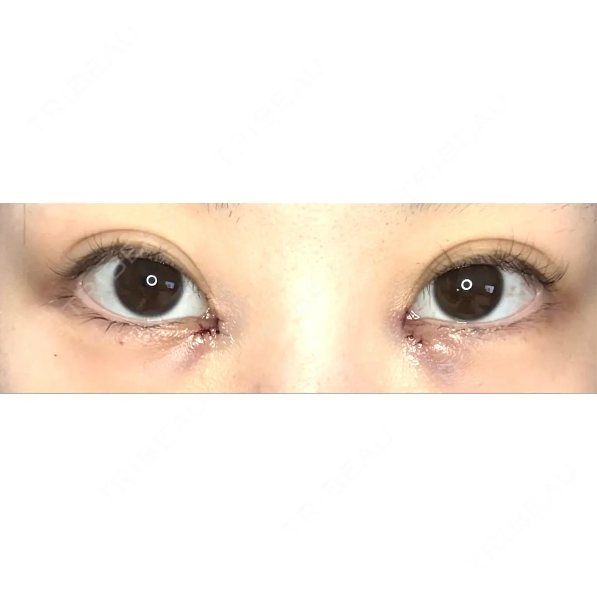 目頭切開 9BeautyClinic DAY 0
