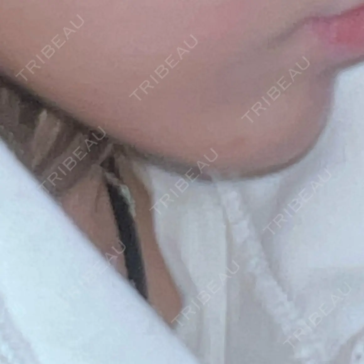 ボトックス（あご） / ヒアルロン酸注入（あご） / ボトックス（エラ・小顔） ルラ美容クリニック 名古屋本院 DAY 1