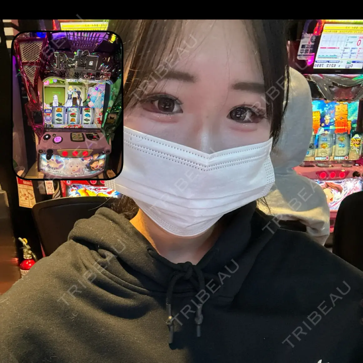 二重埋没 / 目尻切開 / タレ目形成・グラマラスライン（切開） YBC横浜美容外科 池袋院 AFTER