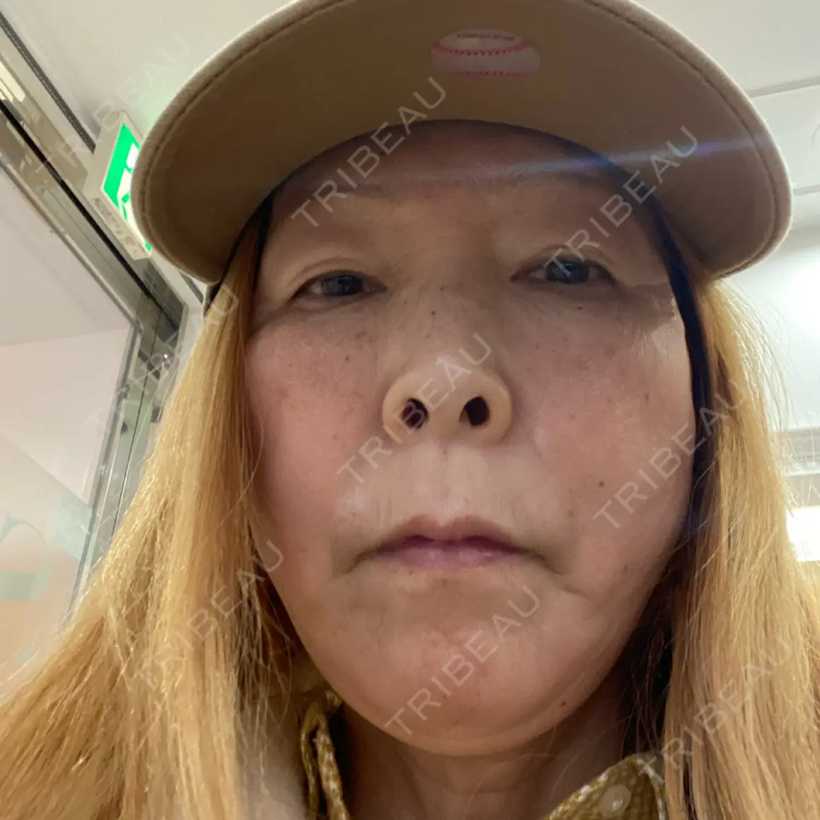 肌ヒアルロン酸注入（たるみ・シワ改善） 湘南美容クリニック 西葛西院 AFTER