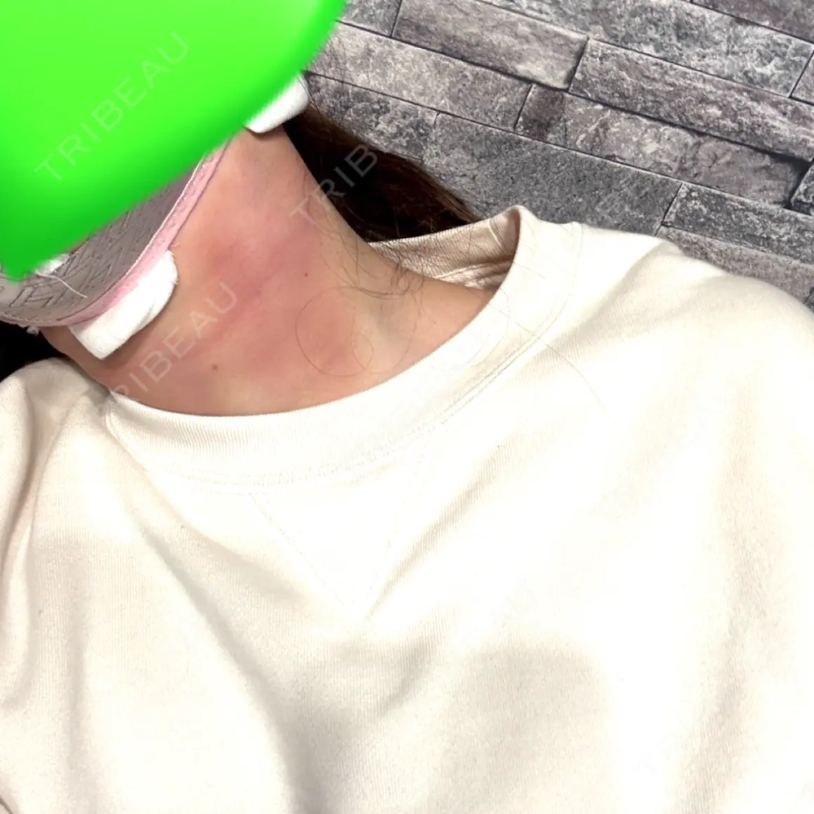 脂肪吸引（顔） くさのたろうクリニック DAY 0