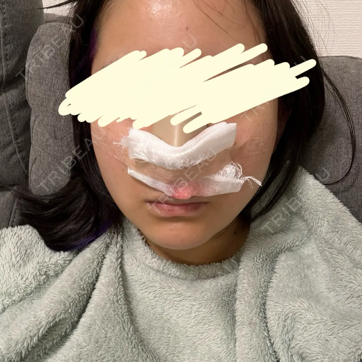 鼻尖形成（切開） / 鼻中隔延長（切開） / 軟骨移植 / ワシ鼻修正・ハンプ切除 / 鼻修正 / その他（鼻） WOM CLINIC GINZA （ワム クリニック ギンザ） DAY 0