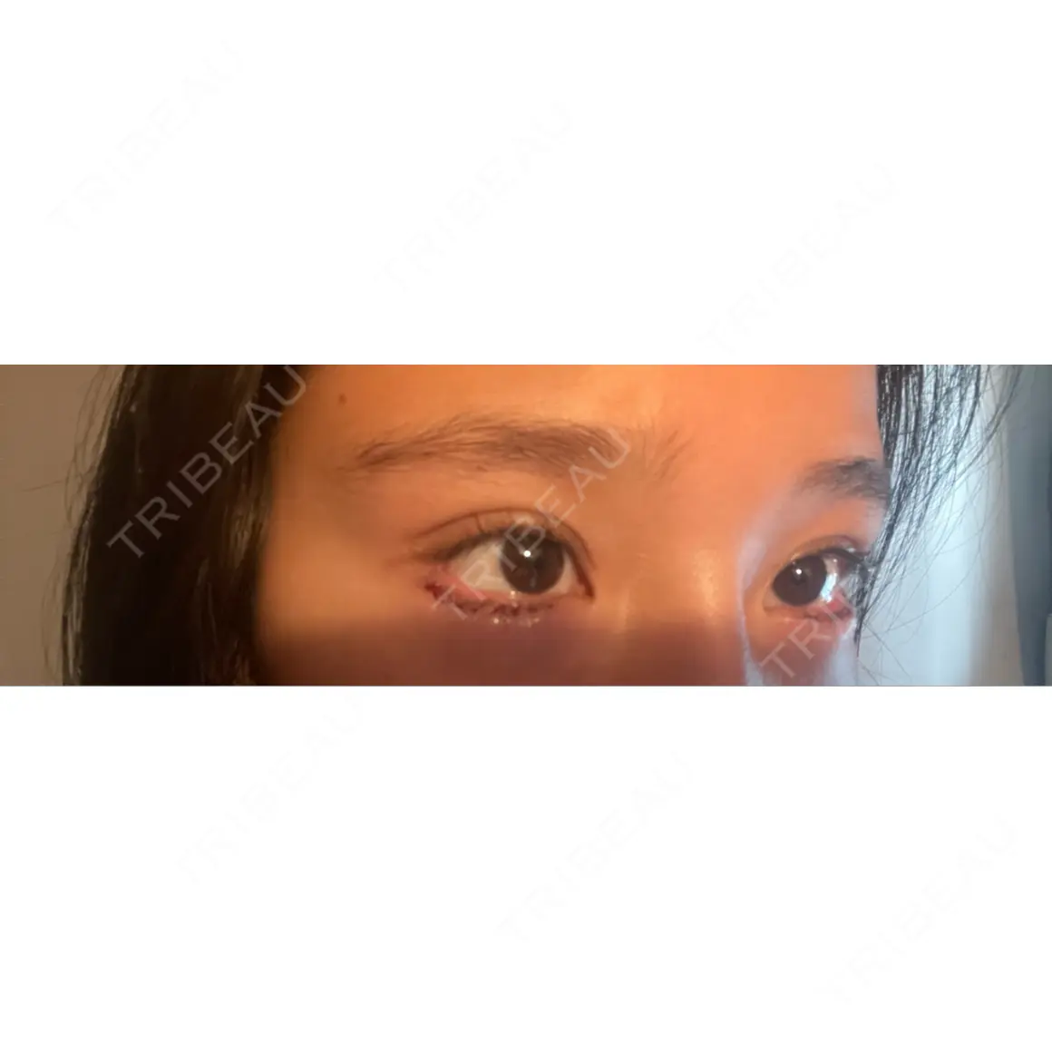 タレ目形成・グラマラスライン（切開） BIANCA銀座 DAY 1