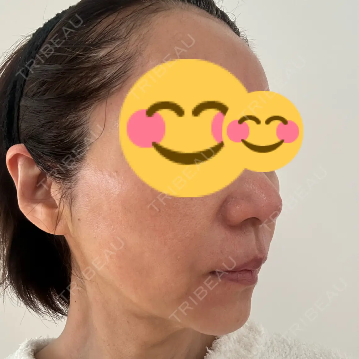 糸リフト X CLINIC 銀座院 AFTER