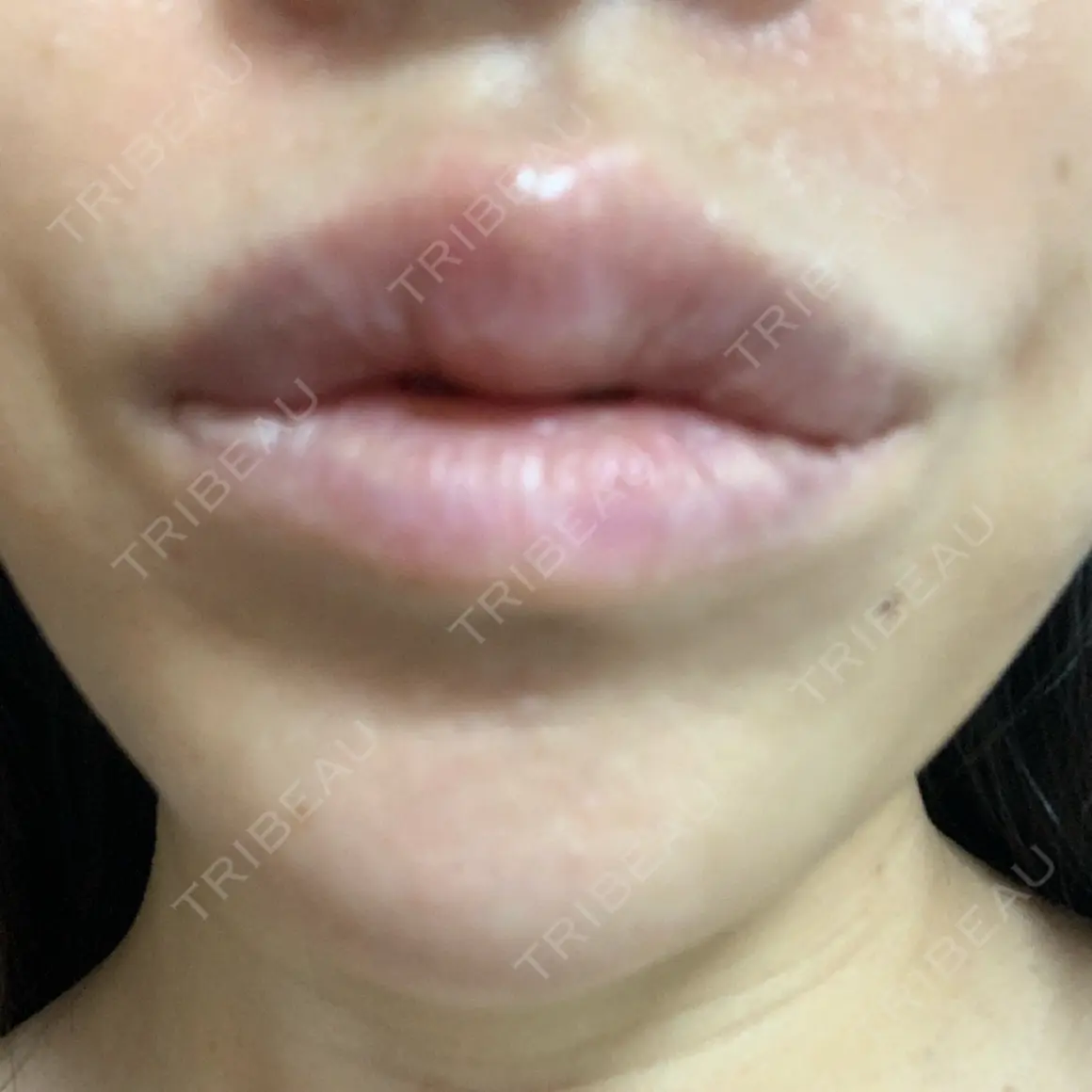 ヒアルロン酸注入（唇） PRO CLINIC プロクリニック 銀座院 DAY 0