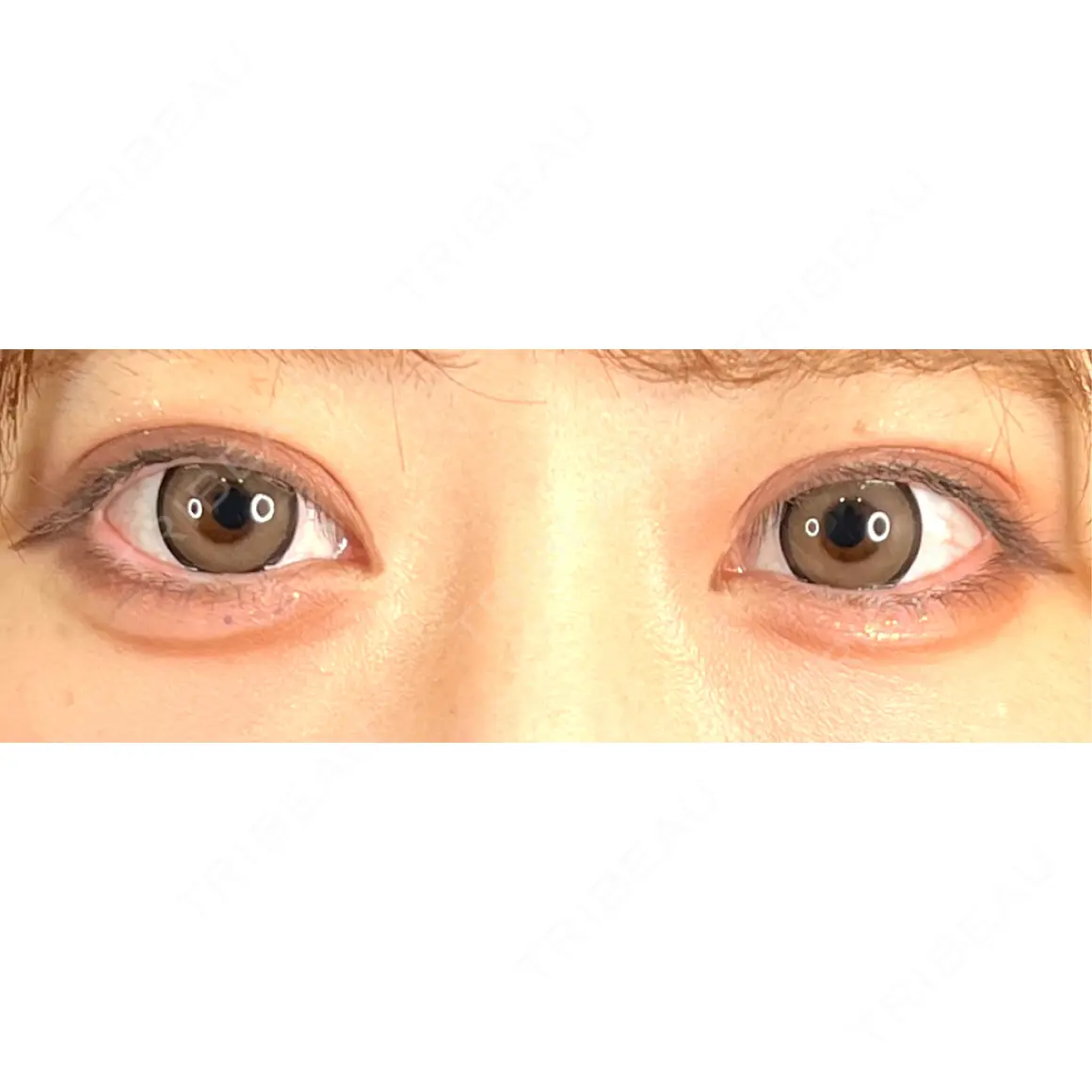二重埋没 藤・ナチュレ美容クリニック 銀座院 AFTER